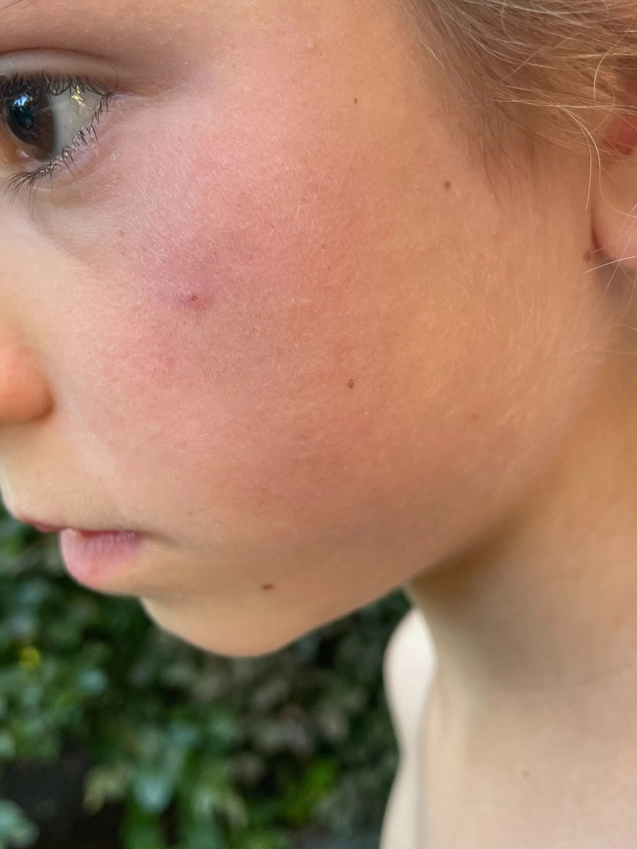 Calm, healthy skin after switching to INCIA natural care