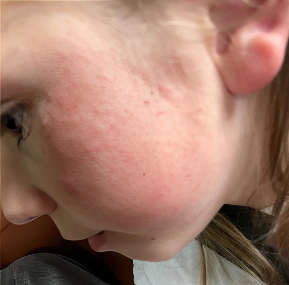 Irritated, eczema-prone skin before INCIA natural care